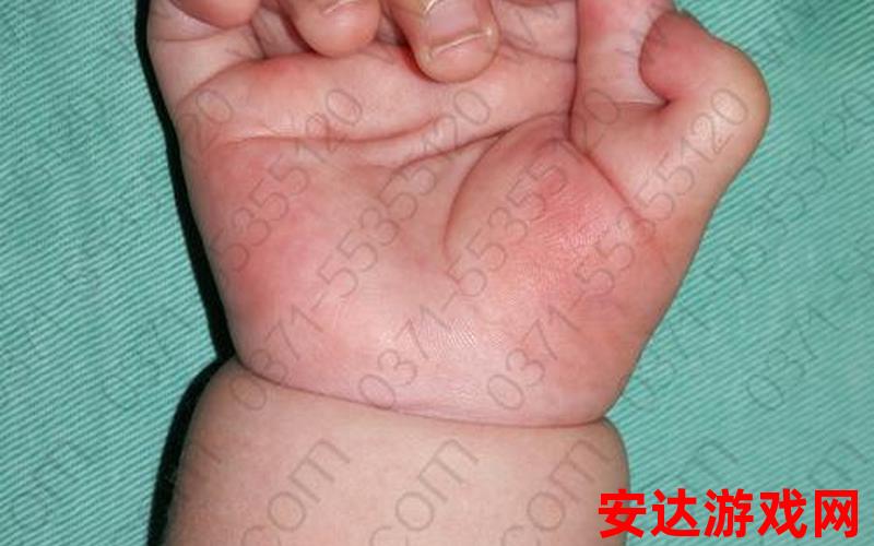宝宝多根手指是基因问题吗：宝宝多根手指是基因问题吗？